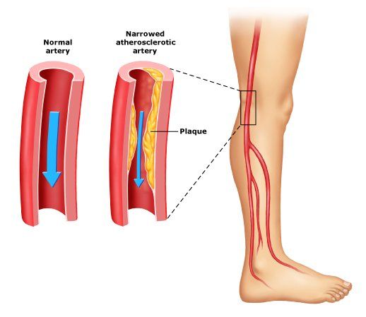 claudication